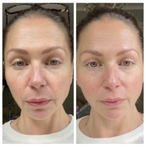 before and after radio frequency facial 